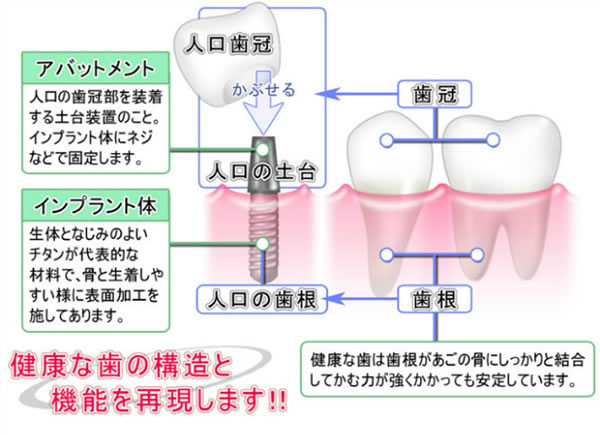 インプラントは自立しますので隣接する歯の支えを必要としません